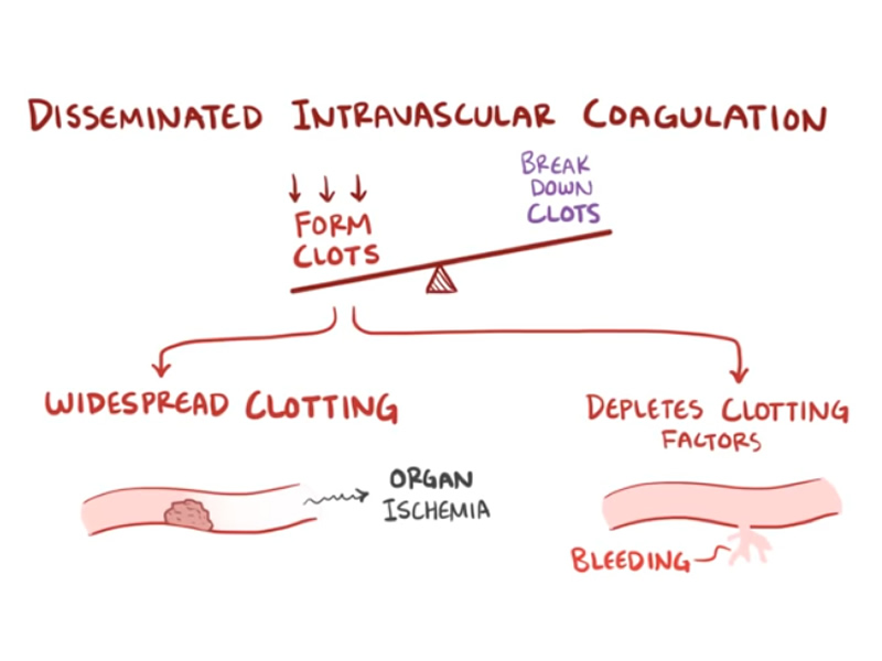 Disseminated Intravascular Coagulation